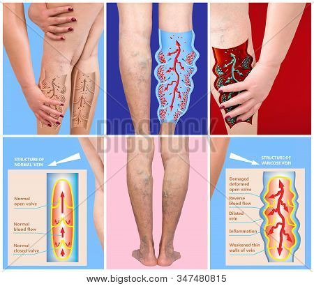 Varicose Veins On A Female Senior Legs. Concept Of Dry Skin, Old Senior People, Varicose And Deep Ve