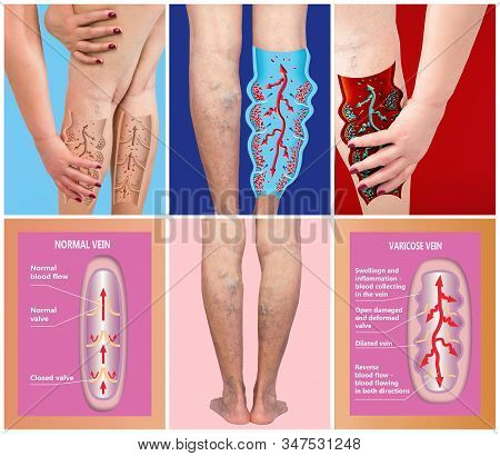 Varicose Veins On A Female Senior Legs. Concept Of Dry Skin, Old Senior People, Varicose And Deep Ve