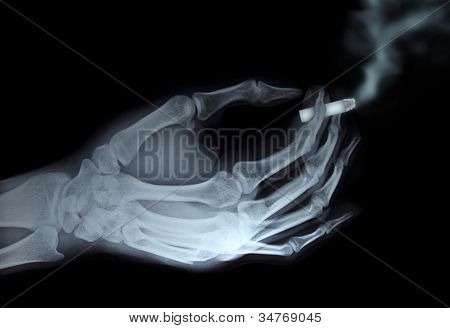 เอกซเรย์มือถือบุหรี่