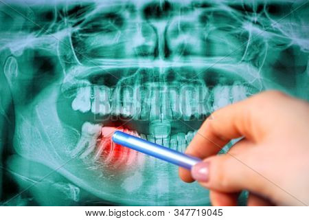 Panoramic Dental Teeth X-ray With A Problem Tooth. Dental Foci.