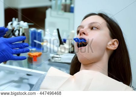 Woman With Denture Mould Impression On Upper Jaw In Dentistry To Create A Prosthesis. Orthodontist T
