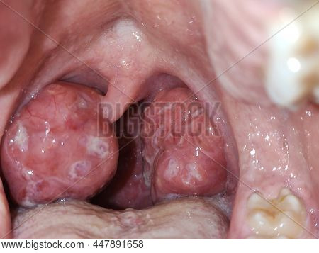 Tonsils. Swollen Tonsils With Plaque Due To Acute Anguineous. Horizontal Photography.