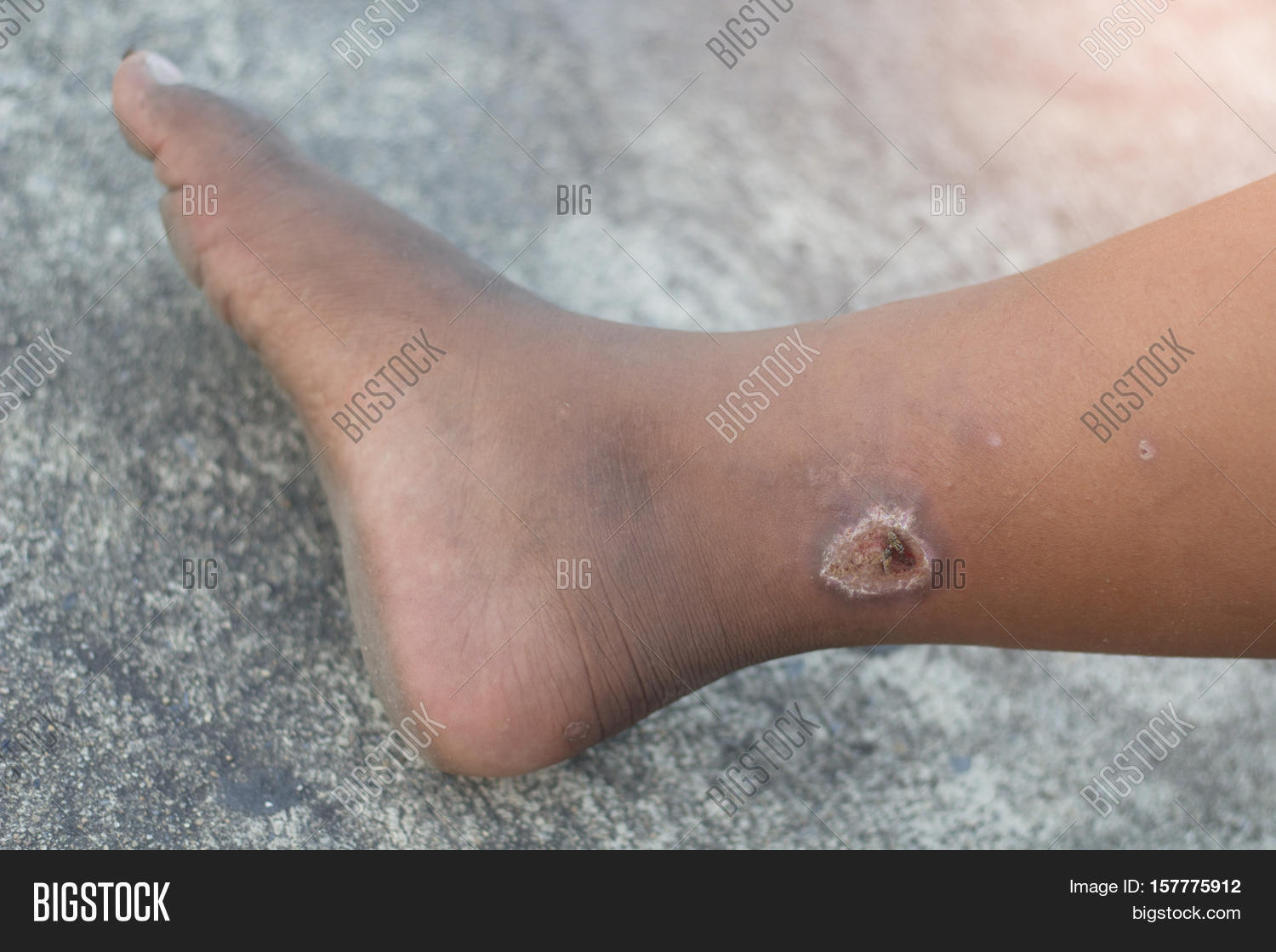 Infected Wound On Leg Image & Photo (Free Trial) Bigstock