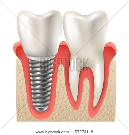 Dental implants and tooth set model closeup side view realistic image vector illustration