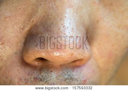 Close up Acne Acne holes welded on Nose and face