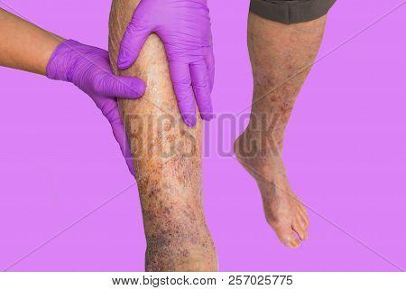 Close-up Of Skin With Varicose Veins On Senior Male Leg. Concept Of Dry Skin, Old Senior People, Var