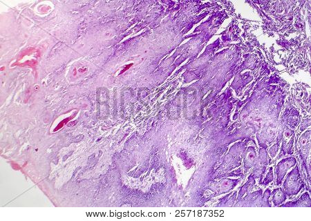 Cutaneous Squamous Cell Carcinoma, Light Micrograph, Photo Under Microscope Showing Typical Keratino