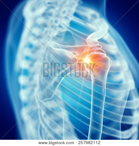 3d rendered medically accurate illustration of a painful shoulder joint