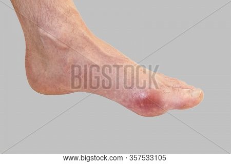 Foot Disease Rheumatism And Gout. Red Leg Swelling. Pain In The Foot.