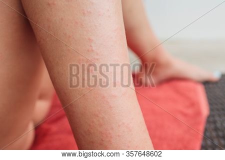 Dermatitis Herpetiformis Skin Rash In A Woman With Nonceliac Gluten Sensitivity. Serum Antibodies Po