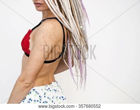 Girl With Bad Skin Acne And Black Red Festering Pimples  On The Face And Body
