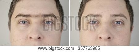 Fused Eyebrows And Sinofreeze In Men. Photo Before And After Modeling Eyebrows In A Guy. Male Self-c