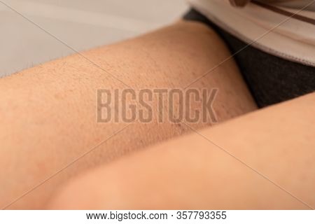 Close Up Picture Of Folliculitis On Human Skin - Hormonal Imbalance