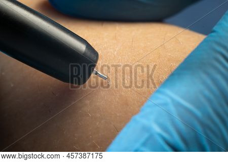 Process Of Permanent Hair Removal, Removing Hair Using An Electroepilation Device, Close-up Macro.
