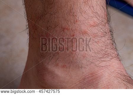 Allergic Reactions To Tick Bites