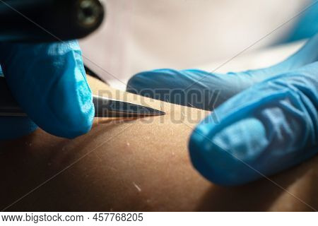 Process Of Hair Removal, Removing Unwanted Hair Using An Electroepilation Device And Tweezers, Close