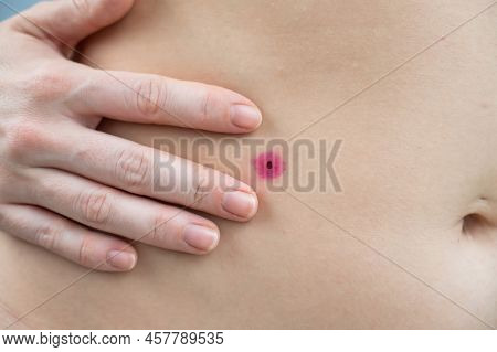 Close-up Of A Removed Wart On A Womans Abdomen. Human Papillomavirus After Burning.