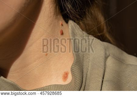 Birthmarks On Skin Close Up Detail Of The Bare Skin Sun Exposure Effect On Skin, Health Effects Of U