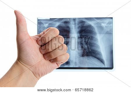 Male hand showing thumbs up next to lung radiography, isolated on white background 