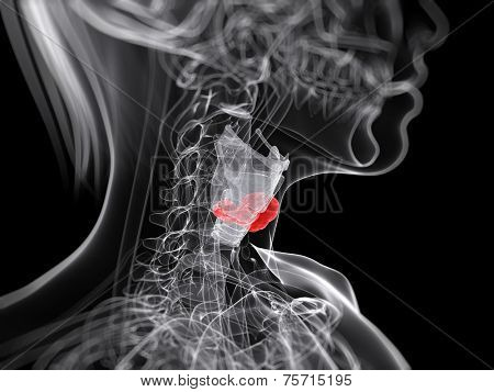 3d rendered medical illustration of larynx cancer