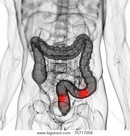 3d rendered scientific illustration of a colon tumor