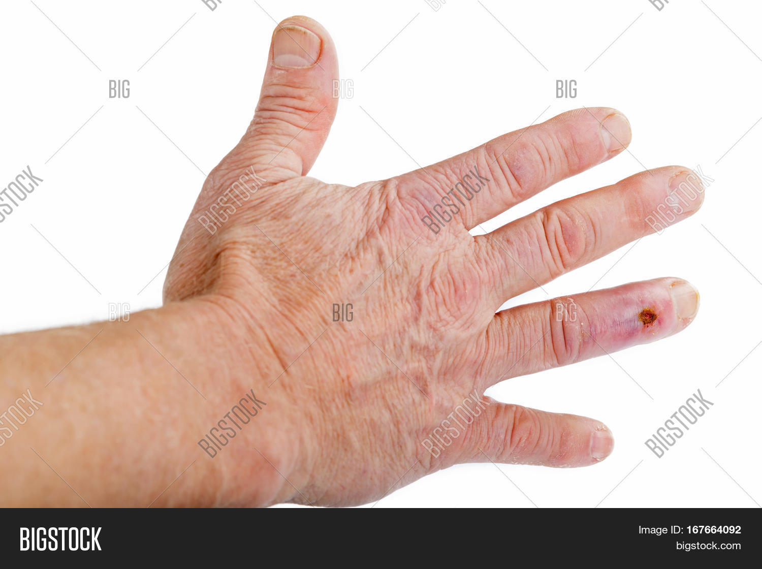 Postoperative Scar On Image & Photo (Free Trial) | Bigstock