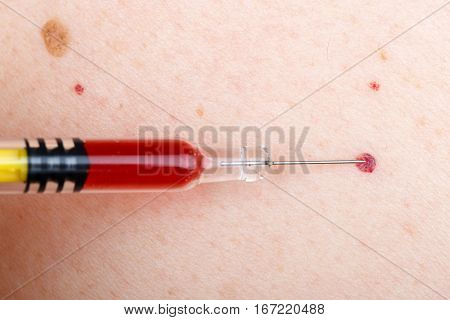 Injection treatment of nevus and cherry angioma
