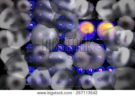 Mrt Of The Heart And Coronary Vessels Using Contrast Fluid And Stress. Collage