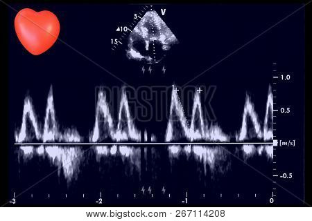 Cardiac Ultrasound Images And Small Heart . Screen Of Echo-cardiography Machine. Doppler Echo