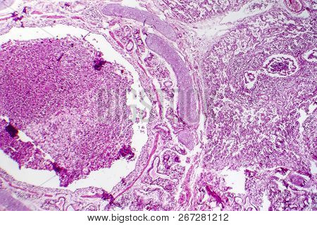 Histopathology Of Bronchopneumonia, Light Micrograph, Photo Under Microscope