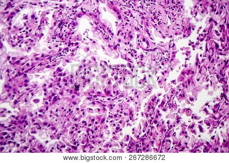 Histopathology Of Lung Cancer, Light Micrograph, Photo Under Microscope