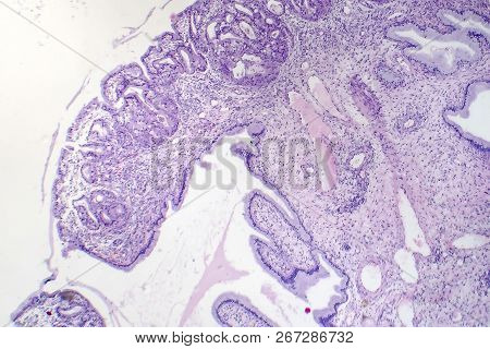Histopathology Of Nasal Polyps, Light Micrograph, Photo Under Microscope