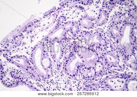 Histopathology Of Nasal Polyps, Light Micrograph, Photo Under Microscope
