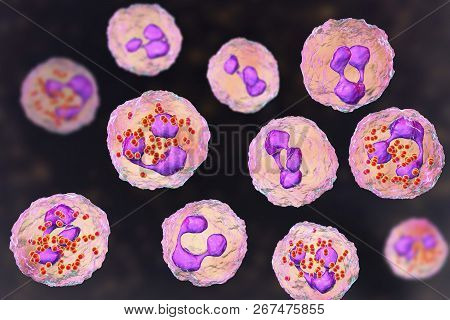 Meningococcal Meningitis, Cerebrospinal Fluid Smear Containing Neutrophils With And Without Bacteria