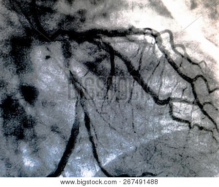 Catheterization. Cardiac Ventriculography Is A Medical Imaging Test Used To Determine A Patient Card