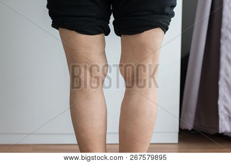 Asian Elderly Woman Leg Bandy-legged Shape Of The Body