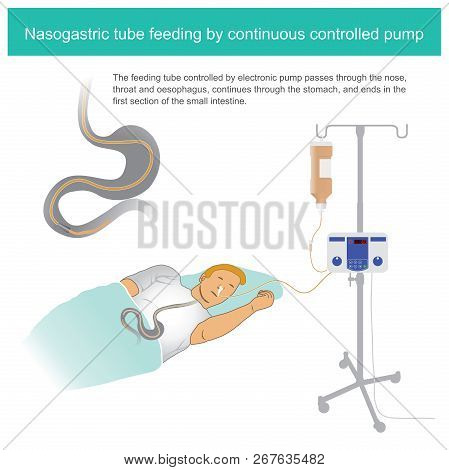 The Feeding Tube Controlled By Electronic Pump Passes Through The Nose, Throat And Oesophagus, Conti