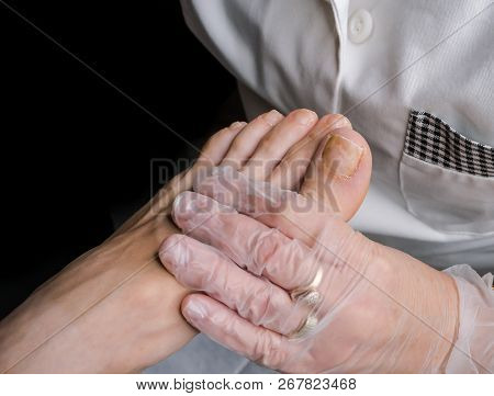 Examination By A Doctor Of Sick Toes. Close Up