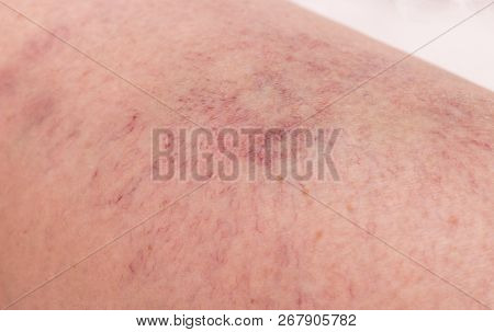 Footprint On The Skin From Vascular Dilatation Of Veins, Vascular Pattern On Human Skin, Close-up, P
