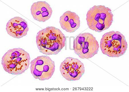 Meningococcal Meningitis, Cerebrospinal Fluid Smear Containing Neutrophils With And Without Bacteria