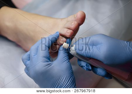 Podology Treatment. Podiatrist Treating Toenail Fungus. Doctor Removes Calluses, Corns And Treats In