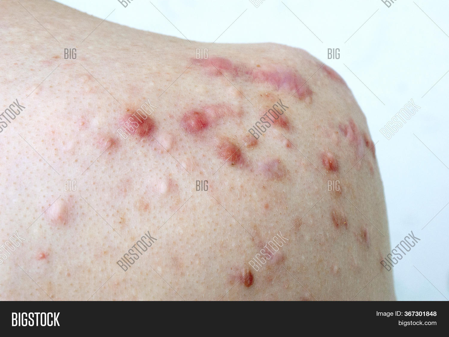 Keloids Scars On Back Image & Photo (Free Trial) Bigstock