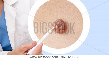 Dermatology, Close Up Mole, Cancer Prevention. Observation Of Moles, Removal Of Large Moles, Warts O