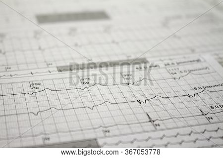 Three-channel Holter Ekg Strip Showing Heartbeat Waves. Electrical Activity Of The Heart Recorded On