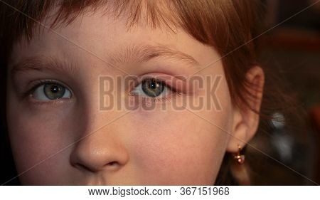 Barley In The Eye. A Child With Barley In His Eye. Inflammation Of The Eyelid. Human Disease.