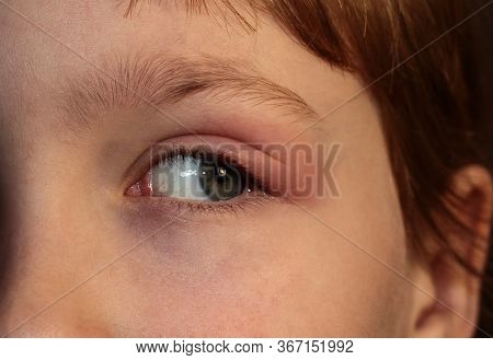 Barley In The Eye. A Child With Barley In His Eye. Inflammation Of The Eyelid. Human Disease.