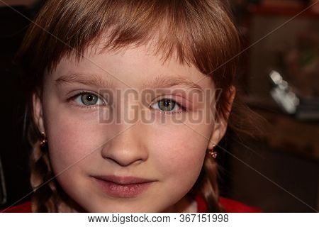 Barley In The Eye. A Child With Barley In His Eye. Inflammation Of The Eyelid. Human Disease.