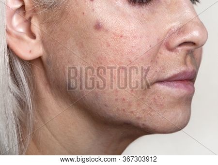 Consequences On The Skin Of The Face, Resulting From Beauty Injections-biorevitalization. Correction