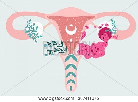 Women Health - Floral Infographic Of Ovarian Cyst Rupture With Leaking Fluid. Patient-friendly Schem