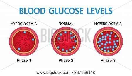 Hyperglycemia, High Blood Sugar And Diabetes ,obesity Is A Serious Medical Condition Causes, Vector 